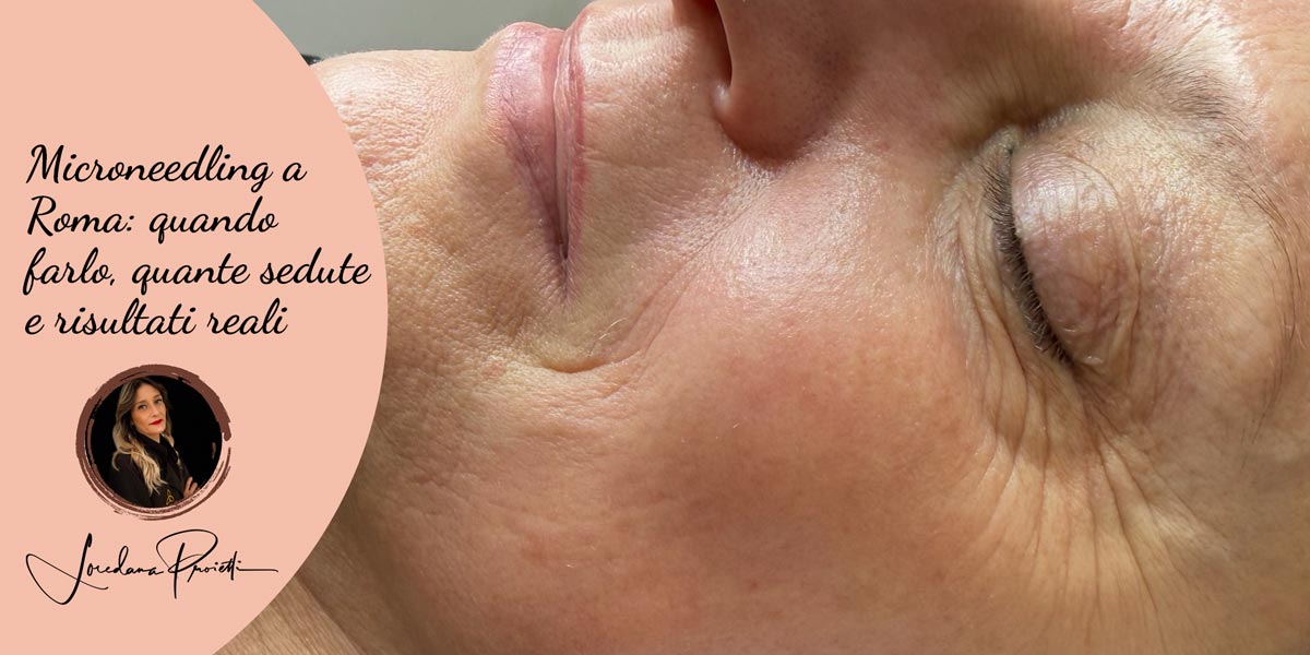 Microneedling a Roma: quando farlo, quante sedute servono e risultati reali