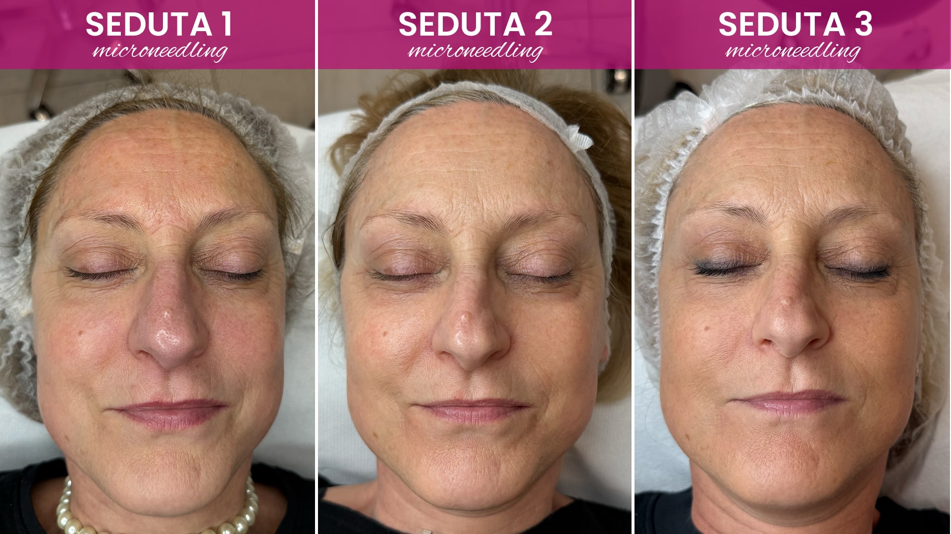 microneedling effettuato su mia cliente in tre sedute